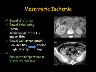 Mesenteric Ischemia
 Bowel dilatation
 Bowel thickening
>8mm
transmural infarct -
paper thin
 Bowel wall attenuation
low density edema
high density hge

Pneumatosis/portomese
nteric venous gas
 