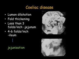 Coeliac disease
• Lumen dilatation
• Fold thickening
• Less than 3
folds/inch -jejunum
• 4-6 folds/inch
-ileum
jejunisation
 