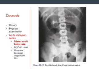 Diagnosis
• History
• Physical
examination
• Acute abdomen
series
• Dilated small
bowel loop
• Air-Fluid Level
• Absent or
decrease
large bowel
gas
 