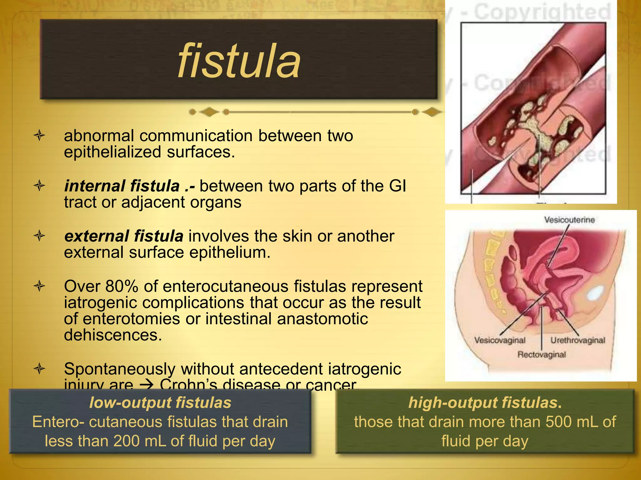Small bowel obstruction and Intestinal Fistulas | PPTX | Digestive