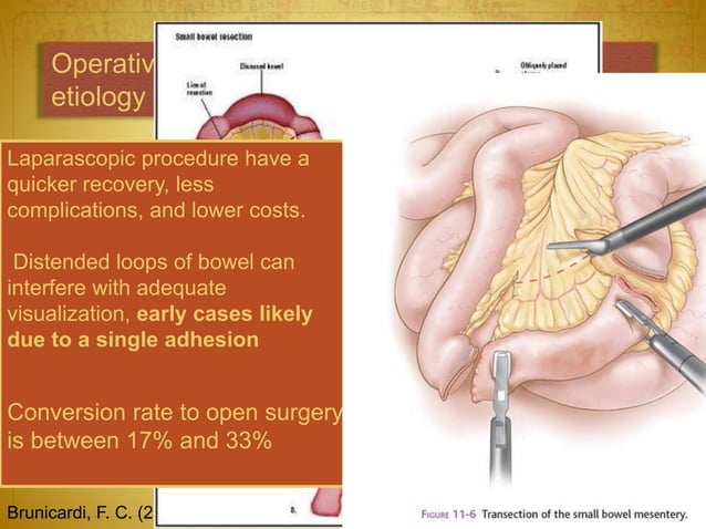 Small Intestine Injury Small bowel obstruction and Intestinal Fistulas | PPTX | Digestive ...