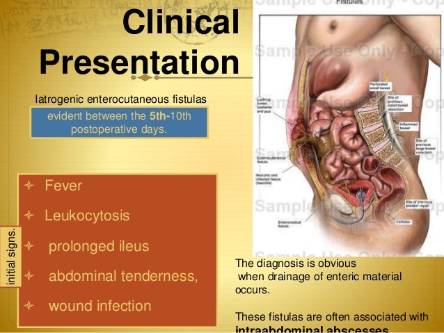 intestinal blockage timeline small bowel obstruction and intestinal fistulas intestinal blockage timeline small bowel obstruction and intestinal fistulas