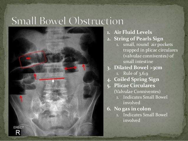 small-bowel-obstruction-power-point