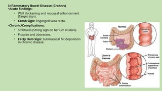 Comprehensive Radioimaging of Small Bowel Pathologies and Obstructions ...