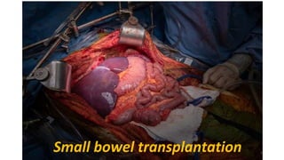 Small bowel transplantation 1
 