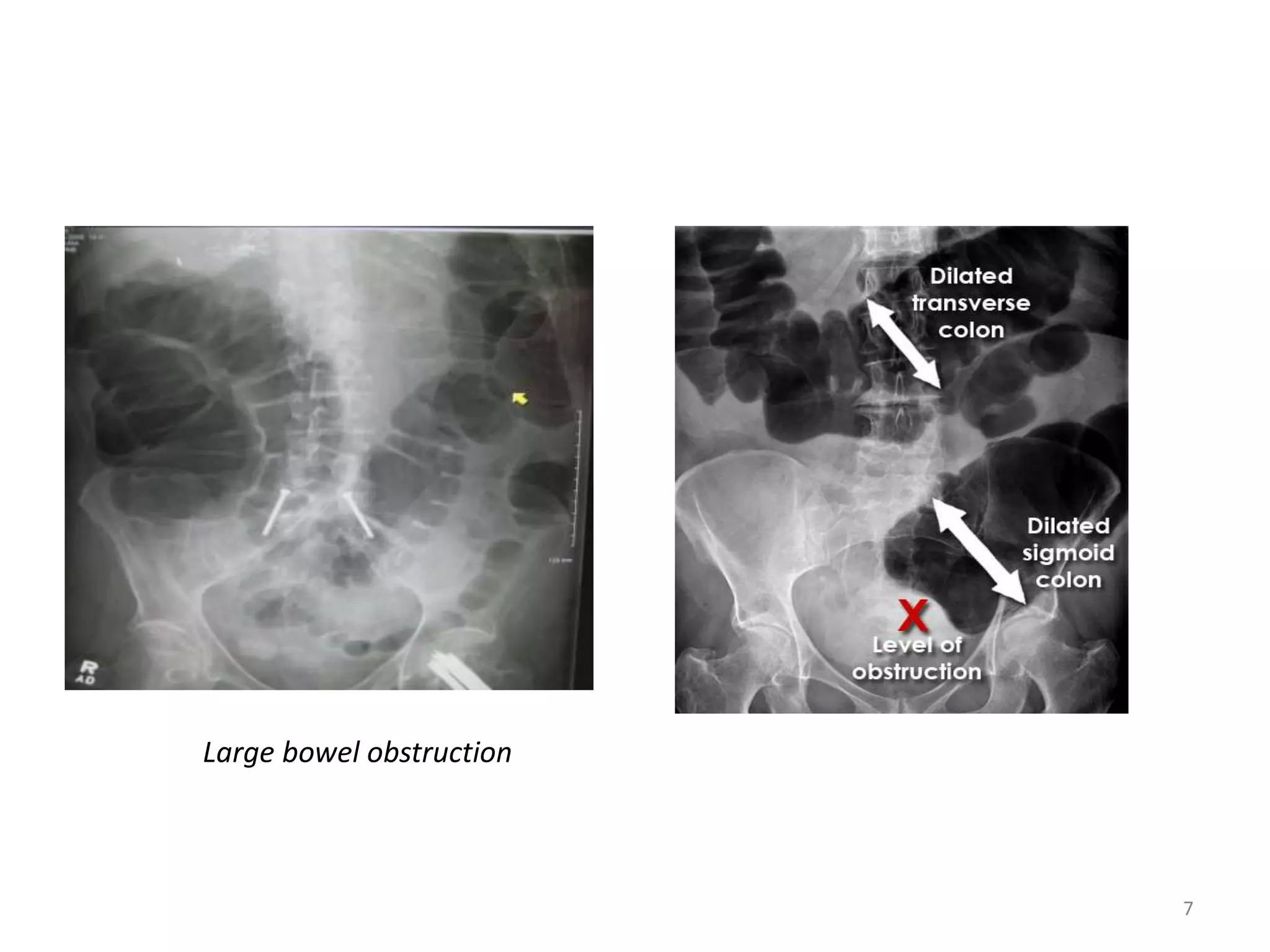 Small bowel vs large.pptx