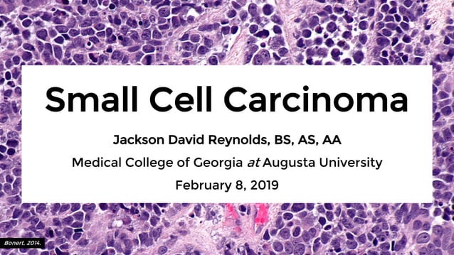 Small Cell Fosc Small Cell Carcinoma – A Pathologic Survey | PPT