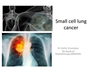 Small cell lung
cancer
Dr Astha Srivastava
SR,Deptt of
Radiotherapy,SRMSIMS
 