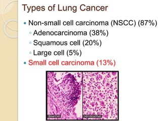 Small cell lung cancer | PPTX