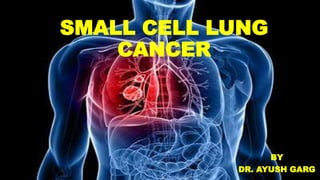 SMALL CELL LUNG
CANCER
BY
DR. AYUSH GARG
 