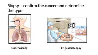 Biopsy - confirm the cancer and determine
the type
Bronchoscopy CT guided biopsy
 