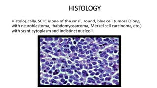 HISTOLOGY
Histologically, SCLC is one of the small, round, blue cell tumors (along
with neuroblastoma, rhabdomyosarcoma, Merkel cell carcinoma, etc.)
with scant cytoplasm and indistinct nucleoli.
 