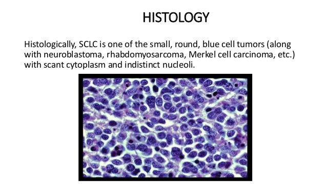 Small cell lung cancer