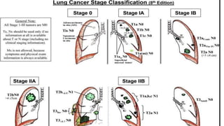 Small cell lung carcinoma anatomy to management | PPTX