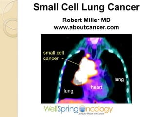 Small Cell Lung Cancer
Robert Miller MD
www.aboutcancer.com
 