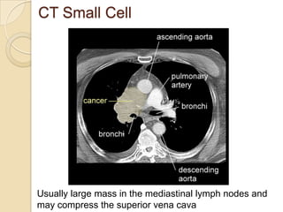 CT Small Cell
Usually large mass in the mediastinal lymph nodes and
may compress the superior vena cava
 
