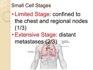 Small Cell Stages
• Limited Stage: confined to
the chest and regional nodes
(1/3)
• Extensive Stage: distant
metastases (2/3)
 