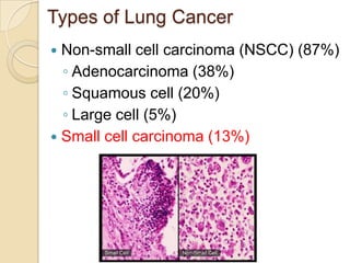 Types of Lung Cancer
 Non-small cell carcinoma (NSCC) (87%)
◦ Adenocarcinoma (38%)
◦ Squamous cell (20%)
◦ Large cell (5%)
 Small cell carcinoma (13%)
 