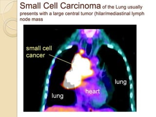 Small Cell Carcinoma of the Lung usually
presents with a large central tumor (hilar/mediastinal lymph
node mass
 