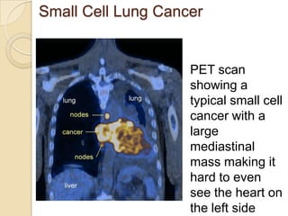 PET scan
showing a
typical small cell
cancer with a
large
mediastinal
mass making it
hard to even
see the heart on
the left side
Small Cell Lung Cancer
 
