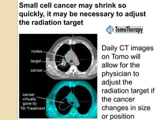 Small cell cancer may shrink so
quickly, it may be necessary to adjust
the radiation target
Daily CT images
on Tomo will
allow for the
physician to
adjust the
radiation target if
the cancer
changes in size
or position
 