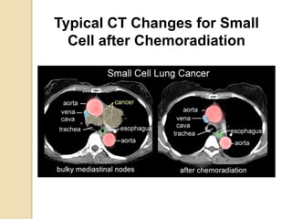 Typical CT Changes for Small
Cell after Chemoradiation
 