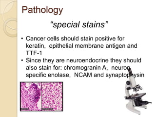 Pathology
• Cancer cells should stain positive for
keratin, epithelial membrane antigen and
TTF-1
• Since they are neuroendocrine they should
also stain for: chromogranin A, neuron
specific enolase, NCAM and synaptophysin
“special stains”
 