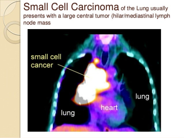Small Cell Lung Cancer