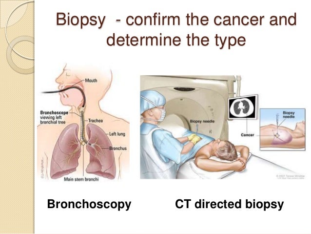 Small Cell Lung Cancer