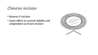 SMALL INCISION CATARACT SURGERY (SICS).pptx