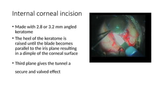 SMALL INCISION CATARACT SURGERY (SICS).pptx
