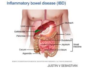 Inflammatory bowel disease (IBD)
JUSTIN V SEBASTIAN
 