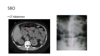 SBO
• CT Abdomen
 