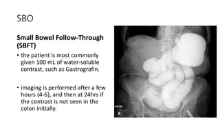 SBO
Small Bowel Follow-Through
(SBFT)
• the patient is most commonly
given 100 mL of water-soluble
contrast, such as Gastrografin.
• imaging is performed after a few
hours (4-6), and then at 24hrs if
the contrast is not seen in the
colon initially.
 