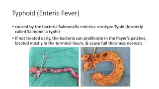Typhoid (Enteric Fever)
• caused by the bacteria Salmonella enterica serotype Typhi (formerly
called Salmonella typhi)
• If not treated early, the bacteria can proliferate in the Peyer’s patches,
located mostly in the terminal ileum, & cause full thickness necrosis.
 