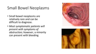 Small Bowel Neoplasms
• Small bowel neoplasms are
relatively rare and can be
difficult to diagnose.
• Most symptomatic patients will
present with symptoms of
obstruction; however, a minority
can present with bleeding
 
