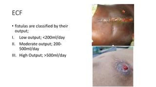 ECF
• fistulas are classified by their
output;
I. Low output; <200ml/day
II. Moderate output; 200-
500ml/day
III. High Output; >500ml/day
 