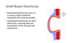 Small Bowel Diverticula
• Small bowel diverticula occur in
as many as 6% of patients
evaluated with contrast studies.
• small bowel diverticula are false
diverticula, meaning they are
herniations of the mucosa and
submucosa
 