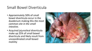 Small Bowel Diverticula
• Approximately 50% of small
bowel diverticula occur in the
duodenum making this the most
common site in the small
intestine.
• Acquired jejunoileal diverticula
make up 25% of small bowel
diverticula and likely result from
uncoordinated small bowel
motility
 