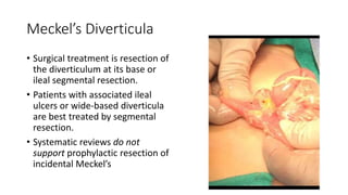 Meckel’s Diverticula
• Surgical treatment is resection of
the diverticulum at its base or
ileal segmental resection.
• Patients with associated ileal
ulcers or wide-based diverticula
are best treated by segmental
resection.
• Systematic reviews do not
support prophylactic resection of
incidental Meckel’s
 