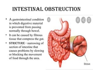 Intestinal obstruction
• A gastrointestinal condition
in which digestive material
is prevented from passing
normally through bowel.
• It can be caused by fibrous
tissue that compress the gut.
• Stricture - narrowing of
section of intestine that
causes problems by slowing
or blocking the movement
of food through the area.
 