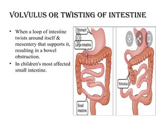 Volvulus or twisting of intestine
• When a loop of intestine
twists around itself &
mesentery that supports it,
resulting in a bowel
obstruction.
• In children's most affected
small intestine.
 