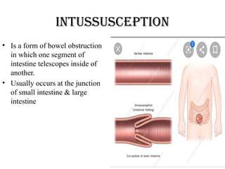 Intussusception
• Is a form of bowel obstruction
in which one segment of
intestine telescopes inside of
another.
• Usually occurs at the junction
of small intestine & large
intestine
 