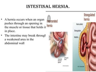 Intestinal hernia.
• A hernia occurs when an organ
pushes through an opening in
the muscle or tissue that holds it
in place.
• The intestine may break through
a weakened area in the
abdominal wall
 