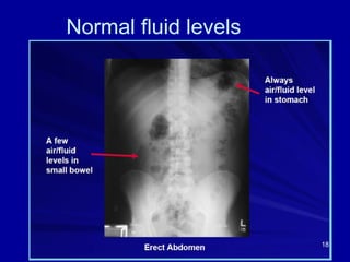 Normal fluid levels
18
 
