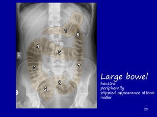 Large bowel
haustra
peripherally
stippled appearance of fecal
matter
20
 