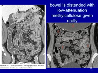 bowel is distended with
low-attenuation
methylcellulose given
orally
40
 