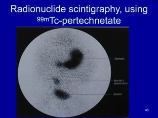 Radionuclide scintigraphy, using
99mTc-pertechnetate
43
 