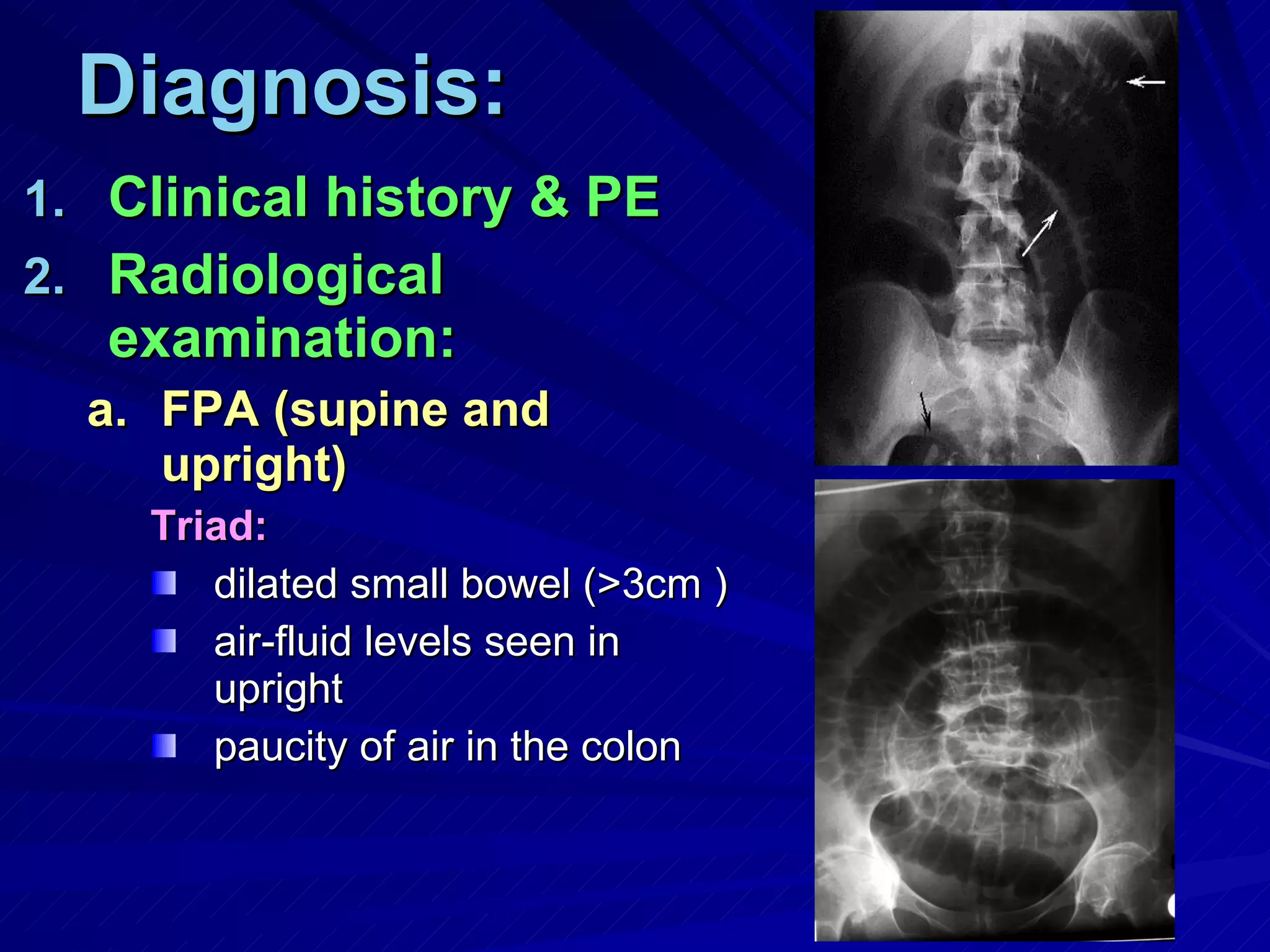 Diagnosis: Clinical history & PE Radiological examination: FPA (supine and upright) Triad:   dilated small bowel (>3cm ) air-fluid levels seen in upright paucity of air in the colon 