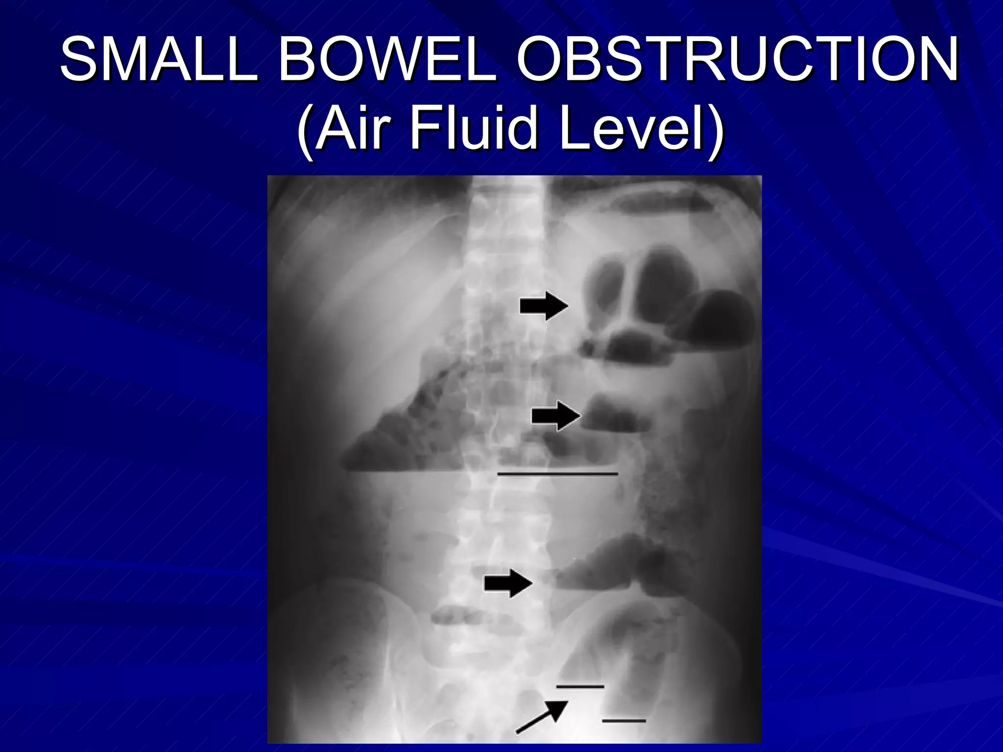SMALL BOWEL OBSTRUCTION (Air Fluid Level) 